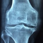 dieta seniora z osteoporozą